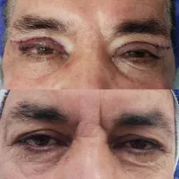 بلفاروپلاستی ساکشن غبغب|خدمات آرایشگری و زیبایی|اصفهان, مهدی آباد|دیوار