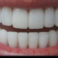 پروتز دندانی وحیدی