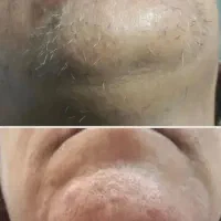 الکترولیز و حذف دائمی موهای زائد صورت