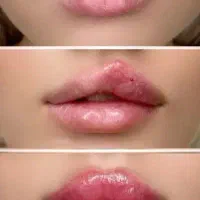 بوتاکس/آنزیم/مزو /جوانساز/ژل