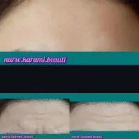 تخفیف بوتاکس و ژل|خدمات آرایشگری و زیبایی|دورود, |دیوار