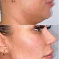 ژل/بوتاکس /فیلر بادی /|خدمات آرایشگری و زیبایی|شیراز, ستارخان|دیوار