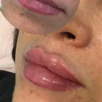 فول فیس ژل بوتاکس پی ار پی  فقط پزشک