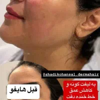 هایفو صورت و غبغب با جنجالی ترین قیمت فقط فردا