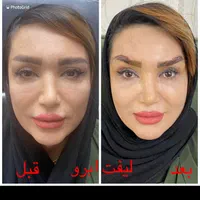 بلفاروپلاستی،لیفت صورت ابرو،اتوپلاستی،لیزر مو تاتو|خدمات آرایشگری و زیبایی|تبریز, |دیوار