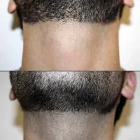 لیزر آقایان و بانوان