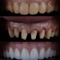 ثبت نام بیمه دندانپزشکی وکامپوزیت وزیبایی دندان|خدمات آرایشگری و زیبایی|گرگان, |دیوار