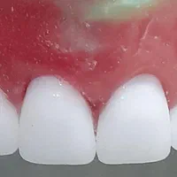 دست دندان مصنوعی با کیفیت عالی و قیمت مناسب|خدمات آرایشگری و زیبایی|تهران, دهکده المپیک|دیوار