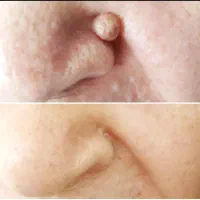 خال برداری ،میخچه زگیل وتمامی زائده هاباقطره گیاهی|خدمات آرایشگری و زیبایی|اصفهان, شفق|دیوار