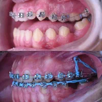 ارتودنسی فقط ۱۳ میلیون اقساط بدون چک.|خدمات زیبایی و سلامت|تهران, جردن|دیوار