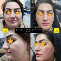 لیفت وجوانسازی با نخ های کاگ و تزریق فیلر ومزوها|خدمات آرایشگری و زیبایی|شیراز, میانرود|دیوار