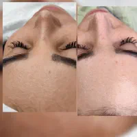 فیشیال پوست