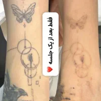 خال برداری، پاک کردن تتو، بلفاروپلاستی در تهران