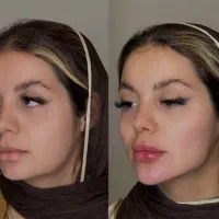 تزریق ژل فیلر/بوتاکس/prp پوست مو/پی آر پی/مزوتراپی|خدمات آرایشگری و زیبایی|کرج, گوهردشت|دیوار