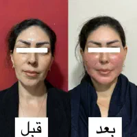 ژل‌.لیفت تخصصی صورت بانخ.افزایش سایزآلت تناسلی آقا