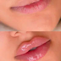 تخفیف ژل و بوتاکس ویژه فقط برای فردا|خدمات آرایشگری و زیبایی|مشهد, شهید معقول|دیوار