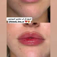 آموزش و انجام تمام خدمات ژل و بوتاکس|خدمات آرایشگری و زیبایی|هشتگرد, شهرک ولیعصر (مصلی)|دیوار