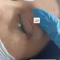 پاک کردن تتو صورت و بدن