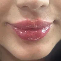 تزریق ژل از ۱۴۹۰ ،بوتاکس از ۶۵۰، پکیج فول فیس ۹/۵|خدمات آرایشگری و زیبایی|تهران, گلستان (شهرک راه آهن)|دیوار