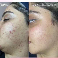 تخفیف پاکسازی پوست ویژه بانوان|خدمات آرایشگری و زیبایی|رشت, صفاری|دیوار