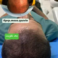 پی آر پی مو و صورت تخفیف ویژه پی ارپی بعدازکاشت مو|خدمات آرایشگری و زیبایی|قزوین, |دیوار