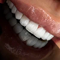 کامپوزیت لمینیت ایمپلنت با کمترین قیمت
