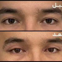 بلفارو(برداشتن پلک)کلینیک معتبر هاشمیه