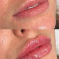 ژل لب فیلر گونه چانه زاویه فک هایفو بلفاروپلاستی