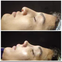 جراحی زیبایی بینی