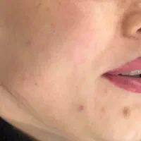 برداشتن انواع خال و لک و کک و مک|خدمات آرایشگری و زیبایی|نورآباد, |دیوار