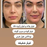 اموزش فیلر و بوتاکس پی ار پی .مزوتراپی|خدمات آموزشی|کرمانشاه, |دیوار