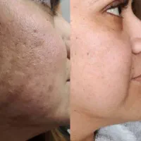 رفع تیرگی جوش جای جوش و آکنه و لک