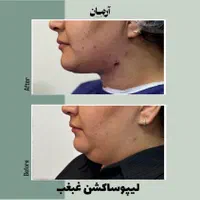 لیپو ساکشن غبغب و بوکال فت ( + شرایط )|خدمات آرایشگری و زیبایی|مشهد, گلبرگ شمالی|دیوار