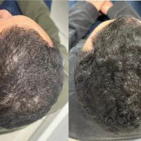 رویش دوباره مو