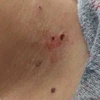 برداشتن خال لیزر ژل و بوتاکس مامایی طب سنتی