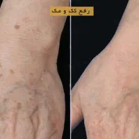 لیزر ، الکترولیز ، روشن سازی ، کک‌ و مک توسط پزشک|خدمات آرایشگری و زیبایی|بندرعباس, |دیوار