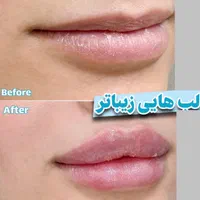 تخفیف50 درصدژل وبوتاکس فقط این چندروز(ظرفیت محدود)