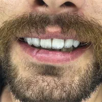 کامپوزیت دندان لمینت دندان  ایمپلنت