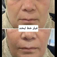 تزریق ژل وبوتاکس و آموزش فیلر با 5سال سابقه کاری|خدمات آرایشگری و زیبایی|جیرفت, |دیوار
