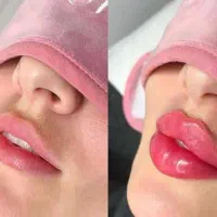 آموزش ژل،بوتاکس،فیلربادی،پیرسینگ،خالبرداری