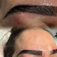 جشنواره کاشت ابرو به روش جراحی و غیر جراحی