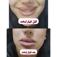 بوتاکس ژل فیلر فیلربادی مزوتراپی پی آر پی در مطب|خدمات آرایشگری و زیبایی|زنجان, |دیوار