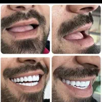 دندان مصنوعی طرح لمینیت دندانسازی