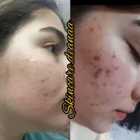 شیدلب.رفع تیرگی.فشیال تخصصی.آموزش.پیراپزشک هستم|خدمات آرایشگری و زیبایی|زاهدان, |دیوار