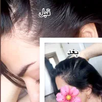 پکیج ضد ریزش مو