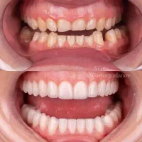 جشنواره ویژه دندان مصنوعی و...فقط 15 تومن|خدمات آرایشگری و زیبایی|فردیس, داوری|دیوار