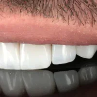 کامپوزیت/لمینیت/ایمپلنت/عصب کشی،و درمانی اقساطی|خدمات آرایشگری و زیبایی|مشهد, جنت|دیوار