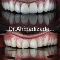 ایمپلنت اقساط با ضمانتنامه مادام العمر|خدمات آرایشگری و زیبایی|تهران, قیطریه|دیوار