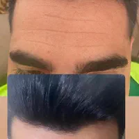 تزریق بوتاکس کل صورت و زیر بغل