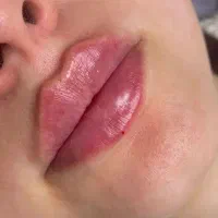 تخفیف فیلر لب تکنیک m